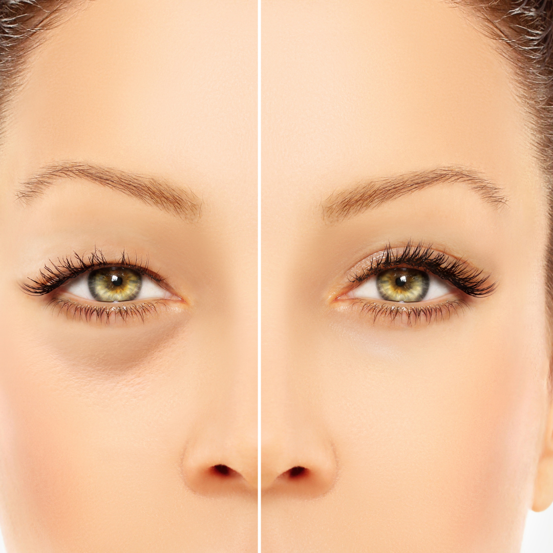 Blepharoplasty