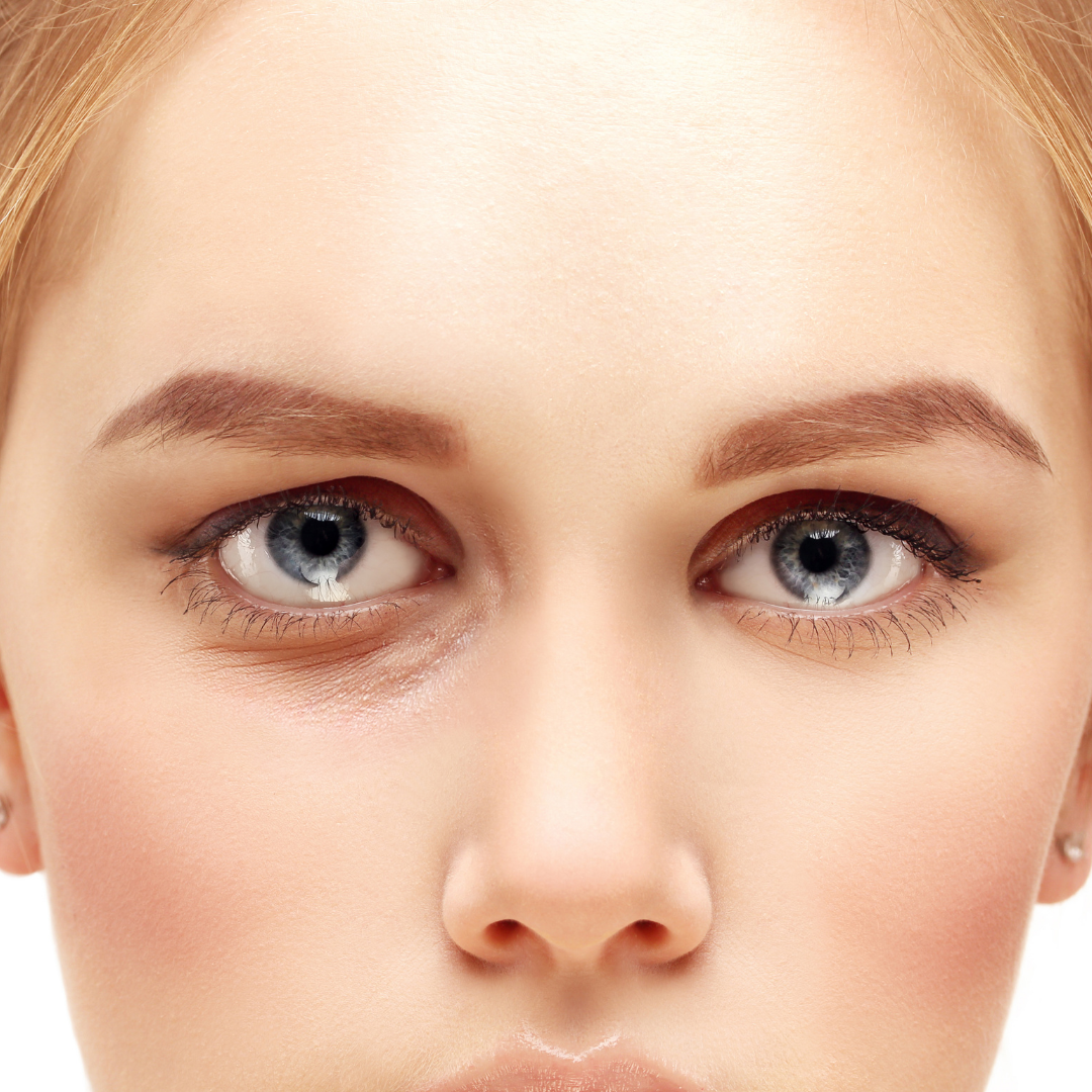 Blepharoplasty